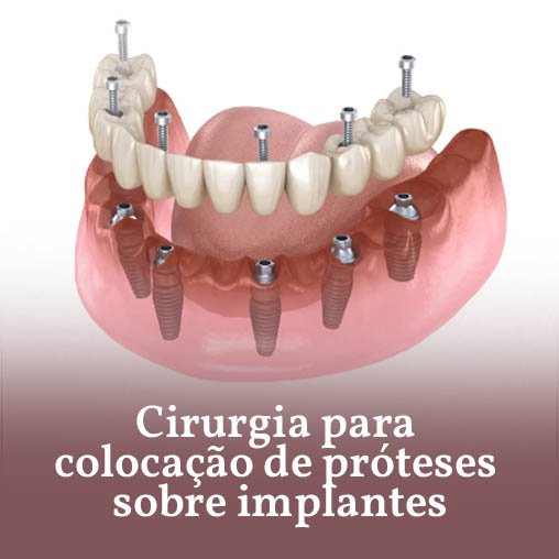 Cirurgias para colocação de próteses sobre implantes