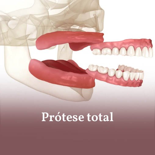 Protese Total