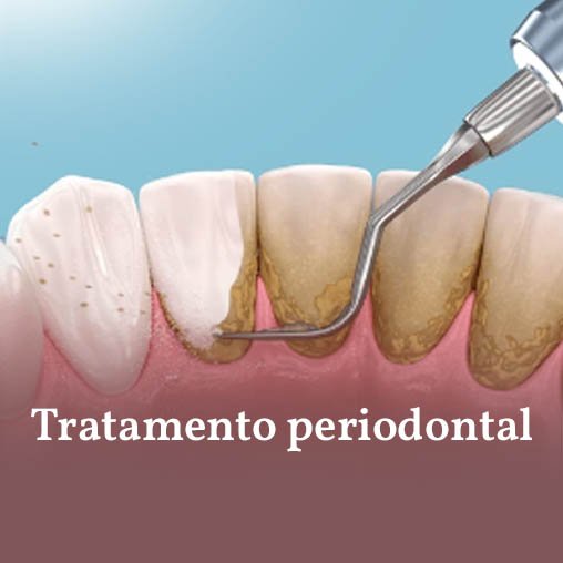 Tratamento periodontal